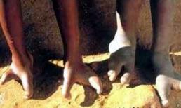 Những bàn chân kỳ lạ nhất thế giới