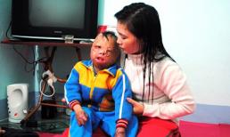 Gặp lại cậu bé hai lần bị cha đẻ tưới xăng