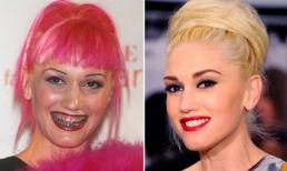 Lộ hàm răng xấu tệ của sao trước thẩm mỹ