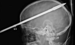 Cậu bé bị xiên cá xuyên qua hộp sọ vẫn sống sót kỳ diệu