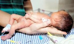 Bé sơ sinh chỉ to bằng... bàn tay người lớn