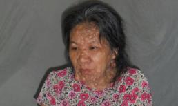 Phận đời cô đơn của người đàn bà mắc bệnh ‘thân hình quỷ’