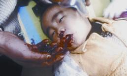 Bé trai 3 tuổi ho ra "dị vật" gây kinh hoàng