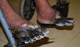 Kinh hoàng hai bàn chân người sống bỗng chết khô