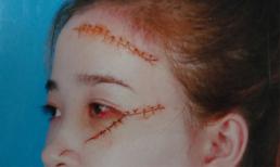 Bị bạn trai chặn đường rạch mặt