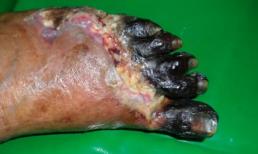 Nhiều trường hợp bệnh chân, tay 'chết khô'