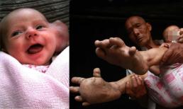Những em bé mang bệnh quái dị trên thế giới