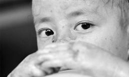 Bé gái bị bong da mỗi lần thay quần áo