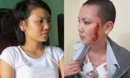 Cô gái bị xăm rết lên mặt đã khỏi vết sẹo
