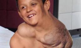 Cậu bé mang khối u khổng lồ trên vai