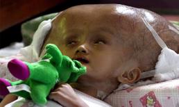 Thương xót em bé đầu phình to ở Indonesia