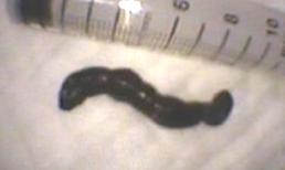 Bắt con đỉa sống ra khỏi thực quản