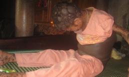 Căn bệnh lạ khiến bé gái 9 năm phải mang thân hình “người thú”