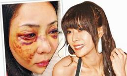 Chân dài bị người tình đại gia đánh nát mặt