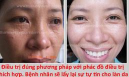 Kinh nghiệm điều trị mụn thịt quanh mắt