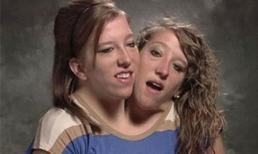 Cuộc sống kỳ lạ của cô gái 2 đầu