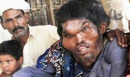 Những khuôn mặt biến dạng vì bệnh lạ