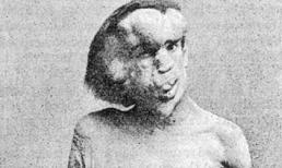 Khám phá bí ẩn “người voi”