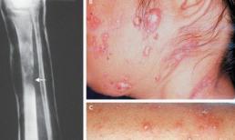 Bệnh "lạ" giống HIV/AIDS xuất hiện ở Việt Nam