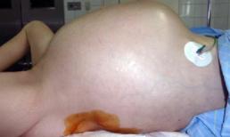 Hòa Bình: Cắt bỏ thành công khối u nặng 15 kg