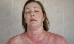 Người phụ nữ bị lột da như rắn