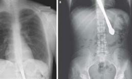 Một phụ nữ nuốt phải dao vì cười vô duyên