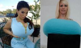 Khốn khổ vì ngực 'phì đại'