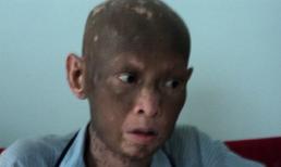 Bệnh lạ khiến một người sụt 40kg, lột da