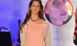 Cô gái “giấu mụn” nổi tiếng nhất YouTube trở thành người mẫu