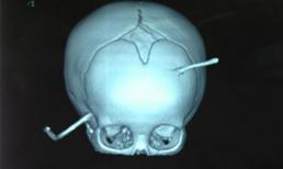 Bị thanh sắt đâm xuyên đầu, bé 10 tháng tuổi sống sót thần kỳ