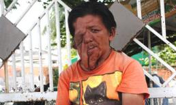 Nỗi đau người đàn ông mang 'khuôn mặt quỷ'