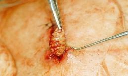 Phát hiện giòi ăn thịt sống dưới da người