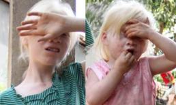 Hai chị em da trắng, mắt đỏ, sợ ánh sáng ở Kon Tum