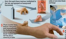 Tái tạo mũi trên cánh tay người