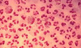 Rùng mình những căn bệnh dễ lây nhiễm qua đường tình dục