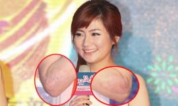 Selina lần đầu tự tin "khoe" sẹo ở tay sau tai nạn