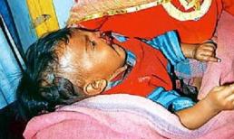 Bé gái bị bố cắn đứt lưỡi vì không nín khóc