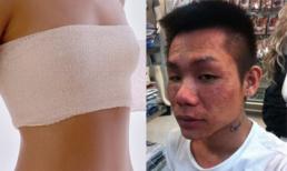 Rùng rợn sưng... mông, mất ngực vì thẩm mỹ