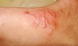 Những con giun lổm ngổm rúc rích dưới da