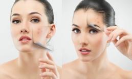Bí quyết hàng đầu điều trị làn da mụn, da dầu