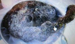 Kinh hoàng búi tóc 200g trong dạ dày bé gái 5 tuổi