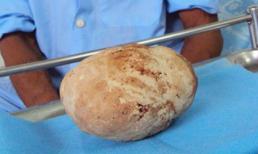 Sỏi nặng gần 1kg nằm trong bàng quang cả thập kỷ