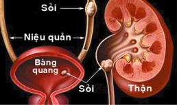 Phòng bệnh sỏi thận bằng ăn uống