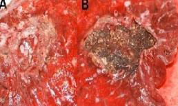 Rùng mình khối nấm khổng lồ mọc trong phổi