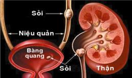 Làm gì khi phát hiện sỏi thận?