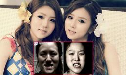 Sốc trước màn "vịt hoá thiên nga" sau thẩm mỹ của chị em sinh đôi xứ Hàn