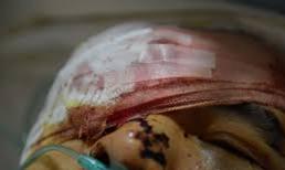 Chồng mua axit thuê người tạt thẳng vào mặt vợ và em vợ