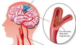 Ðề phòng rối loạn tuần hoàn não