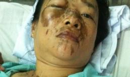 Nạn nhân bị kẻ cuồng yêu tạt axít định tự tử