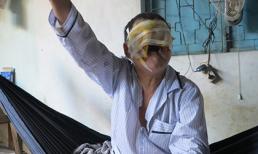 Người đàn ông hóa mặt quỷ chỉ vì tẩy nốt ruồi